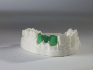 Whip Mix 3D Printed dental crown